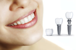 Implant dentar