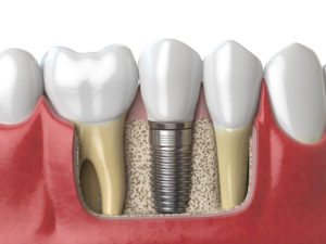 implanturi-dentare