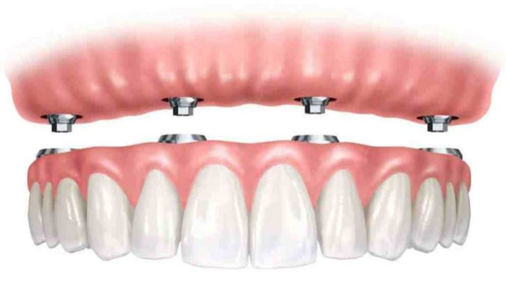 implanturi dentare