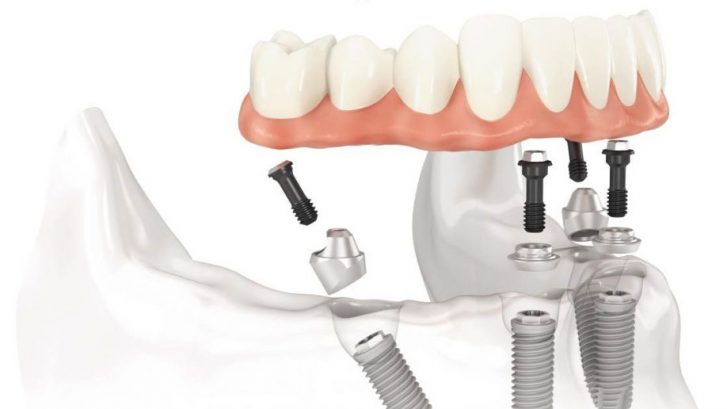 implanturi dentare